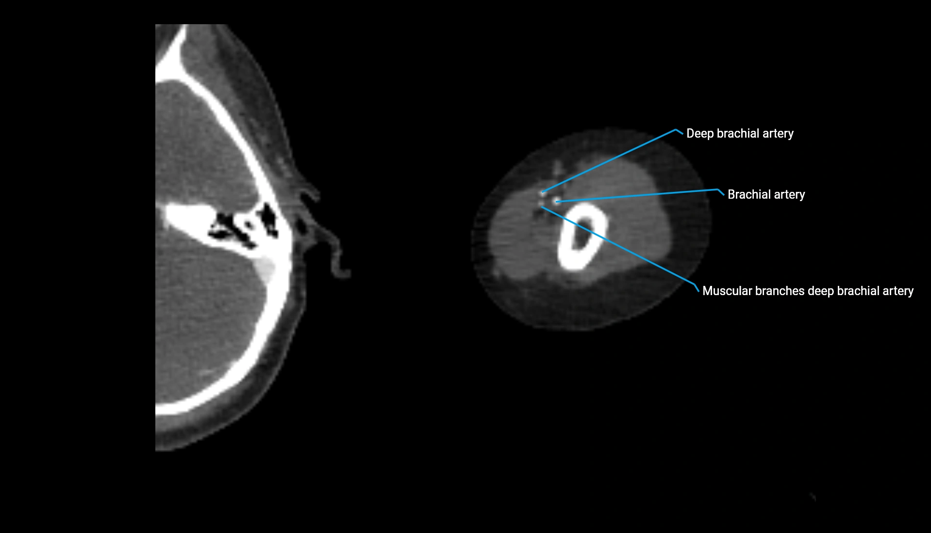CTA upper limb axial cross sectional anatomy labelled image 258 (2).webp